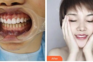 昆明尚愛韓美口腔門診部陸成華整形價(jià)格表附金屬托槽矯正案例展示