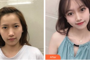 武漢天安整形美容醫(yī)院馬長德整形價格表附自體脂肪填充案例展示