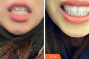 昆明愛雅仕口腔醫(yī)院馬宇飛整形價(jià)格表附隱形托槽矯正案例展示