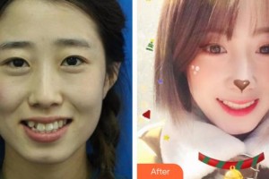 昆明市口腔醫(yī)院馬丁整形價(jià)格表附美白貼片案例展示