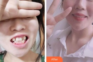 昆明藍橙口腔醫(yī)院吳拓江整形價格表附牙齒隱形矯正案例展示