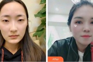 曲靖愛爾眼科醫(yī)院丁云香整形價格表附切開雙眼皮案例展示