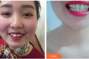 曲靖卓美口腔門(mén)診部梁沙整形價(jià)格表附牙齒隱形矯正案例展示