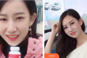 曲靖卓美口腔門(mén)診部張小米整形價(jià)格表附牙齒隱形矯正案例展示