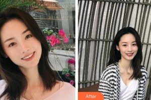 玉溪左醫(yī)生整形美容門(mén)診部左玉萍整形價(jià)格表附去痘印痘坑案例展示