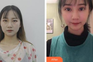 玉溪愛(ài)爾眼科醫(yī)院胡亞麗整形價(jià)格表附眼部綜合案例展示