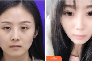 玉溪愛(ài)爾眼科醫(yī)院劉超整形價(jià)格表附眼部修復(fù)案例展示