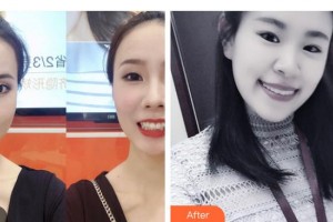 昭通愛(ài)麗諾醫(yī)療美容門診部潘玉支整形價(jià)格表附超聲波潔牙案例展示