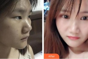 昭通愛(ài)麗諾醫(yī)療美容門診部朱姍姍整形價(jià)格表附埋線雙眼皮案例展示