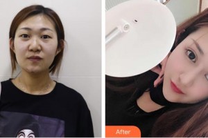 昭通愛(ài)麗諾醫(yī)療美容門診部陳志江整形價(jià)格表附切開(kāi)雙眼皮案例展示