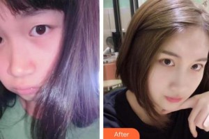 河南省立眼科醫(yī)院王樹林整形價(jià)格表附眼部綜合案例展示