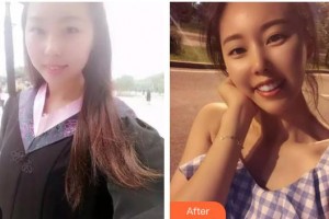 河南省立眼科醫(yī)院黃愛國整形價(jià)格表附切開雙眼皮案例展示