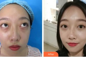 河南省立眼科醫(yī)院郭希讓整形價(jià)格表附上瞼提肌案例展示