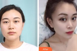 河南省立眼科醫(yī)院王麗婭整形價(jià)格表附眼部綜合案例展示