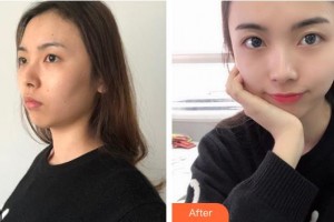 河南省立眼科醫(yī)院賀燚整形價(jià)格表附眼部綜合案例展示