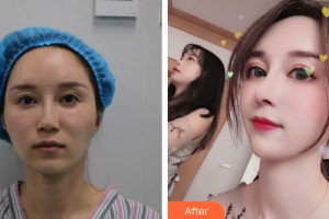 武漢頂吉醫(yī)療美容門診部金亨俊整形價(jià)格表附鼻部手術(shù)案例展示