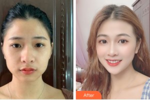 武漢美嘉整形美容醫(yī)院李靜整形價(jià)格表附自體脂肪填充案例展示