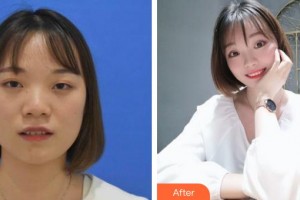 河北現(xiàn)代女子醫(yī)院整形美容中心翟奈穎整形價(jià)格表附定點(diǎn)雙眼皮案例展示