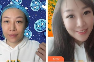 河北醫(yī)科大學(xué)第一醫(yī)院燒傷整形外科齊順貞整形價格表附激光去眼袋案例展示