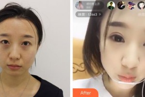 河北工程大學(xué)附屬醫(yī)院整形美容科謝玉娥整形價(jià)格表附切開(kāi)雙眼皮案例展示