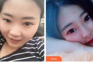 石家莊星源美天醫(yī)療美容醫(yī)院李香梅整形價格表附隆鼻案例展示