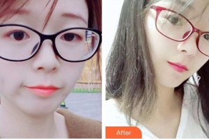 石家莊第一醫(yī)院整形科方克明整形價格表附水氧活膚案例展示