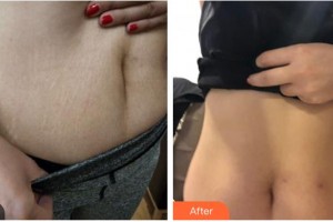 石家莊瑞貝爾醫(yī)療美容門診部何曉婭整形價(jià)格表附祛妊娠紋案例展示
