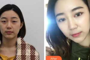 石家莊巍名仕醫(yī)療美容醫(yī)院王麗英整形價(jià)格表附切開(kāi)雙眼皮案例展示