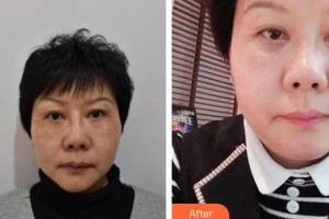 石家莊雅芳亞醫(yī)療美容醫(yī)院賈美樂(lè)整形價(jià)格表附激光去眼袋案例展示