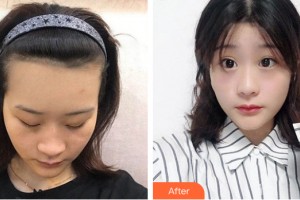 武漢百佳婦產(chǎn)醫(yī)院醫(yī)療美容科丁莉美整形價格表附植發(fā)案例展示