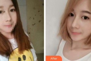 石家莊冀美醫(yī)療美容門診部何曉雅整形價(jià)格表附白瓷娃娃案例展示