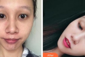 石家莊冀美醫(yī)療美容門診部鄭鳳蘭整形價(jià)格表附清潔祛痘案例展示
