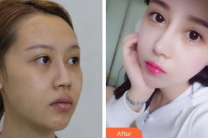 石家莊諾萬醫(yī)療美容醫(yī)院姚華榮整形價格表附牙齒隱形矯正案例展示