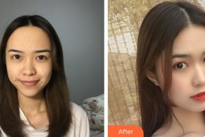 石家莊雍禾植發(fā)醫(yī)院韓巖整形價(jià)格表附種植發(fā)際線(xiàn)案例展示