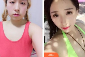 石家莊俏之翼醫(yī)療美容門(mén)診部鄭斌整形價(jià)格表附假體隆胸案例展示