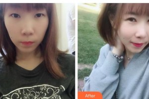 石家莊樂(lè)仁堂萬(wàn)瑞醫(yī)療美容門診部李輝整形價(jià)格表附切開(kāi)雙眼皮案例展示