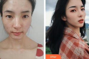 石家莊越然醫(yī)療美容門(mén)診部張鴻超整形價(jià)格表附激光祛斑案例展示
