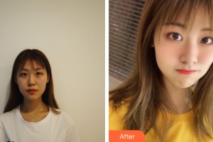 武漢伊麗莎白醫(yī)療美容診所金昌旭整形價格表附眼部手術案例展示