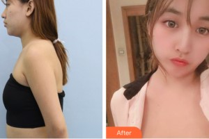 武漢唯韓醫(yī)療美容門診部尹源晙整形價格表附自體脂肪豐胸案例展示