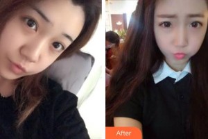 石家莊越然醫(yī)療美容門(mén)診部霍慧珍整形價(jià)格表附鼻部綜合案例展示