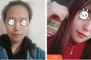 石家莊越然醫(yī)療美容門(mén)診部王寶琦整形價(jià)格表附光子嫩膚案例展示