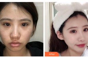 石家莊俏之翼醫(yī)療美容門(mén)診部吳志宏整形價(jià)格表附激光祛斑案例展示