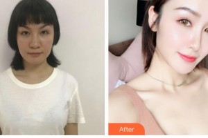 石家莊俏之翼醫(yī)療美容門(mén)診部林東勛整形價(jià)格表附鼻部綜合案例展示