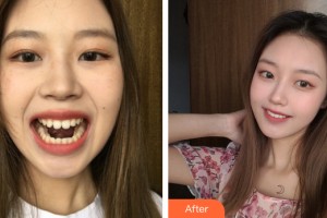 武漢涵美醫(yī)療美容門診部孫瑋整形價格表附牙齒矯正案例展示