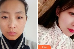 石家莊俏之翼醫(yī)療美容門診部樸智慧整形價(jià)格表附光子嫩膚案例展示