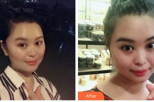 石家莊美萊醫(yī)學(xué)美容醫(yī)院石娟娟整形價格表附紅藍光祛痘案例展示