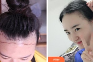 石家莊雍禾植發(fā)醫(yī)院馬曉陽(yáng)整形價(jià)格表附植發(fā)案例展示