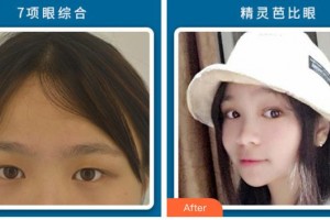 石家莊艾麥德醫(yī)療美容門診部王秀紅整形價(jià)格表附切開(kāi)雙眼皮案例展示