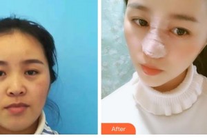 石家莊瑞貝爾醫(yī)療美容門診部李玄整形價格表附鼻部綜合案例展示