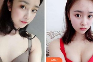 唐山美泉醫(yī)療美容診所王景鋒整形價(jià)格表附自體脂肪隆胸案例展示